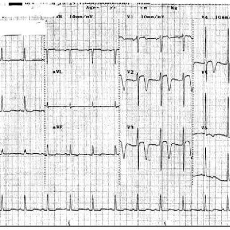 A Resting 12 Lead Electrocardiogram ECG On The First Day Of Admission