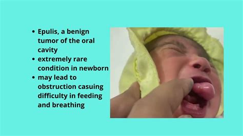 Oral Cavity Mass In Newborn Epulis Youtube