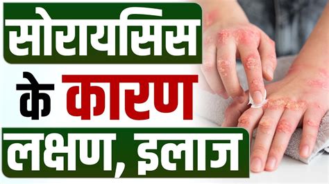 सोरायसिस के कारण लक्षण और इलाज Causes And Symptoms Of Psoriasis