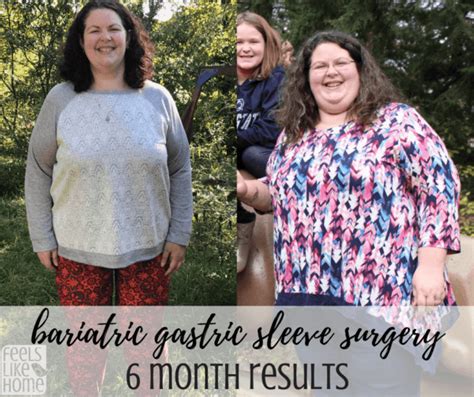 Bariatric Gastric Sleeve Surgery Results Months Post Op Feels