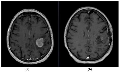 A Pre Operative Mri Of A Left Frontal Gbm B Post Operative Mri It