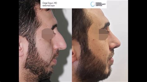 Rhinoplasty Before After Result Ozge Ergun MD Plastic Surgery