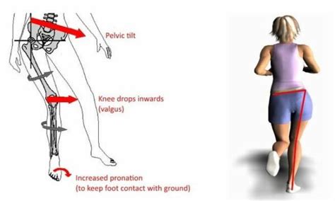 The Fix For Shin Splints That Most People Miss Acl Strong