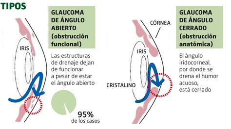 Infografía La Prevención Del Glaucoma Imo