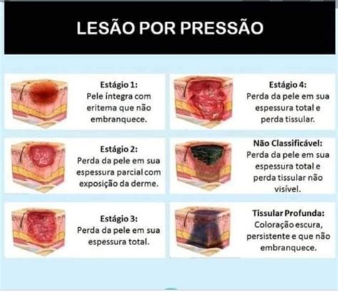 As Feridas Oncológicas São Classificadas De Acordo Com - Como Pode Ser Classificada As Feridas - BRAINCP