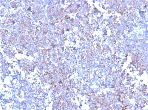 Recombinant Sox11 Mantle Cell Lymphoma Marker Antibody Clone Sox113235r Gene Id 6664