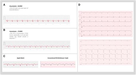 A Single Lead Electrocardiogram Tracings Acquired By The Patient S