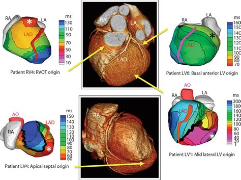 Noninvasive Electroanatomic Mapping Of Human Ventricular Arrhythmias