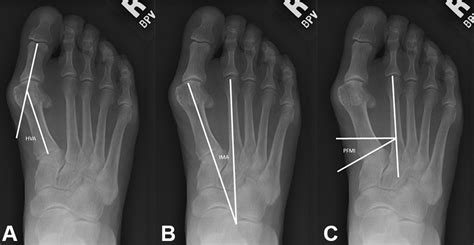 Medial Cuneiform Opening Wedge Osteotomy For The Treatment Of Hallux