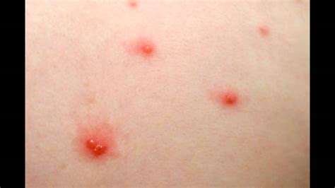 Chicken Pox Symptoms And Facts Youtube