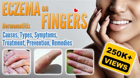 Eczema On Fingers Causes Types Symptoms Treatment And Remedies