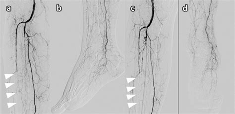 Infected Subcutaneous Hematoma In Percutaneous Deep Venous