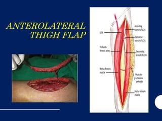 Antero Lateral Thigh Flap PPT