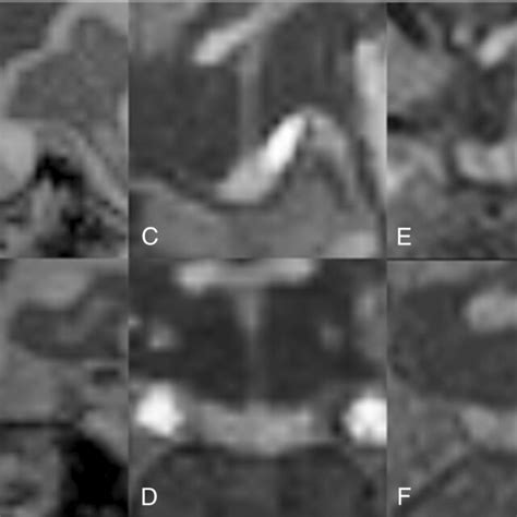 Representative Pituitary Gland Images T1 Weighted Mri Sagittal And