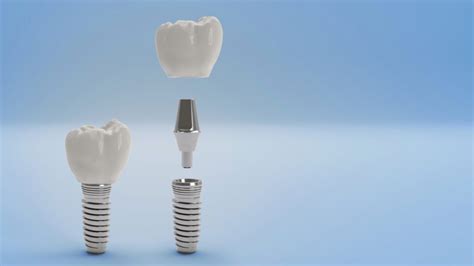 Dental Implants Raleigh Nc Single Tooth Implant Millbrook