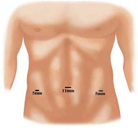 Port Placement For Tapp And Tep Hernia Repair Download Scientific Diagram