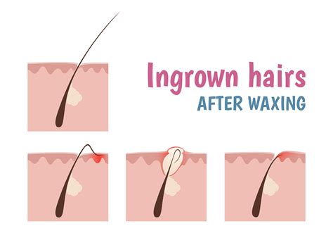 Ingrown Hair Follicle