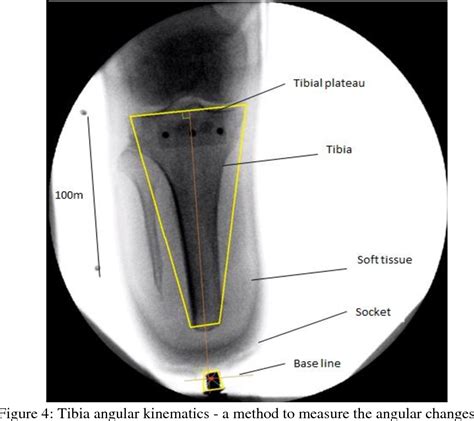 Figure 4 From EVALUATION OF ANGULAR KINEMATICS OF LOWER LIMB AMPUTEES