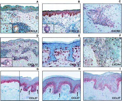 Ultraviolet Radiationinduced Injury Chemokines And Leukocyte