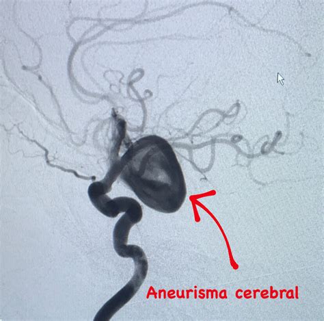 Aneurisma Cerebral Dra Natália Vasconcellos