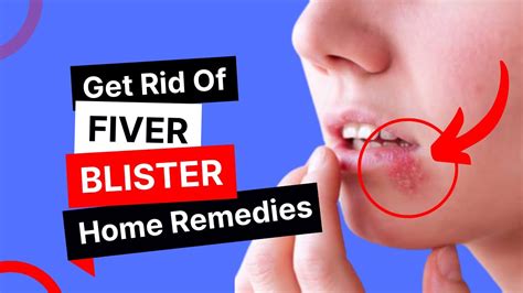 Having Trouble With Fever Blister 5 Infallible Home Remedies To Get