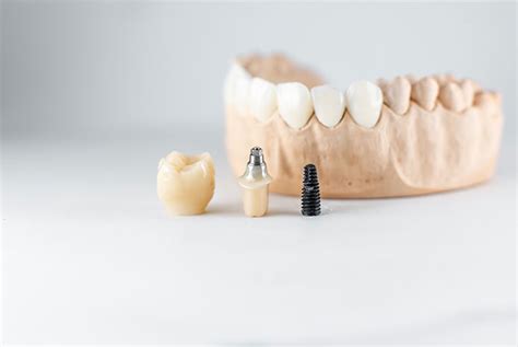 Soluciones CAD CAM sobre implantes dentales un antes y un después