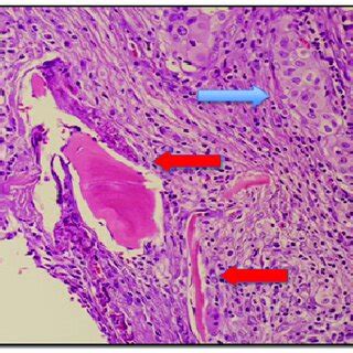 Higher Magnification Shows Nests And Sheets Of Atypical Polyhedral