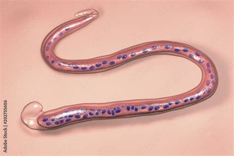 Wuchereria Bancrofti A Roundworm Nematode One Of The Causative Agents Of Lymphatic Filariasis