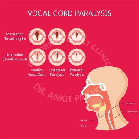 Vocal Cord Palsy In Neonates And Babies Causes Diagnosis And