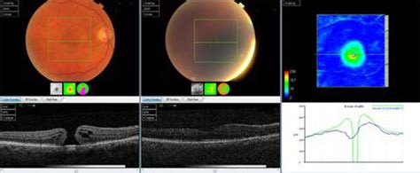 Oct Scan Of One Of The Cases In The Silicone Oil Group Preoperative