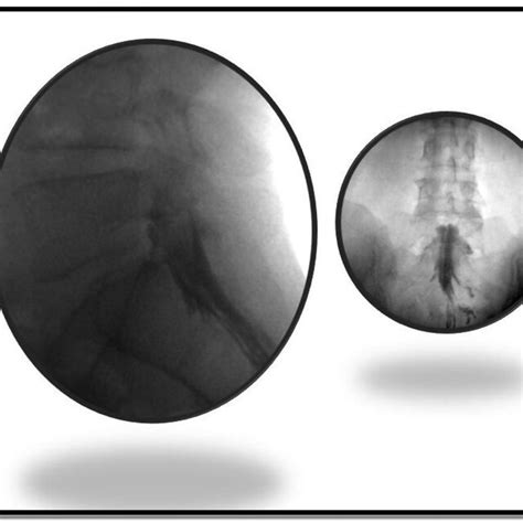 Representative Contrast Distribution Seen On Fluoroscopic Lateral And