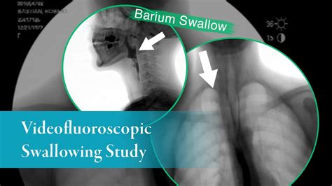 Barium Swallow Barium Esophagram Anterior Posterior View Youtube