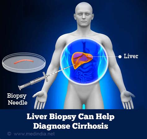 Liver Cirrhosis Causes Symptoms Diagnosis Treatment Prevention