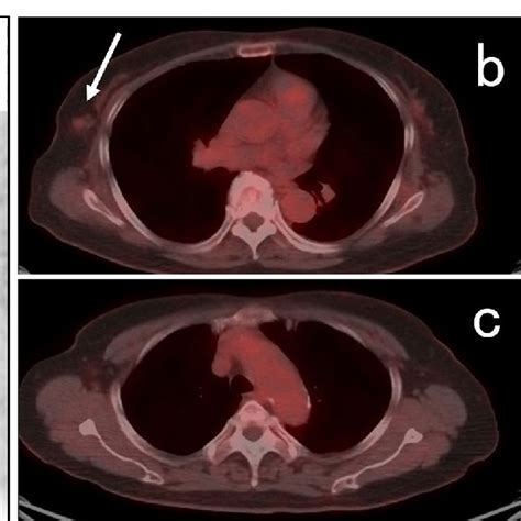 Findings Of Db PET And Whole Body PET CT A B Uptake With SUVmax 2 1