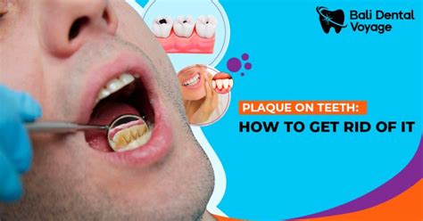 What Is Dental Plaque And How To Remove From Teeth