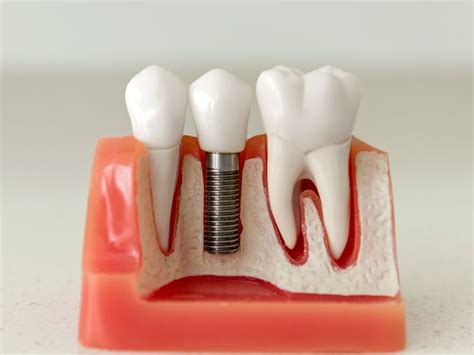 Cómo saber si necesito implantes dentales CLINICA IGCH