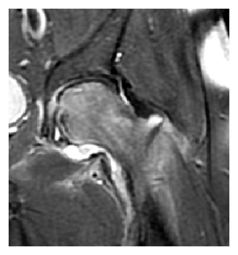 (a) X-ray of a patient with transient osteoporosis of the left hip ...