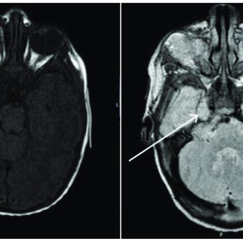 Axial T1 Weighted And T2 Weighted Tse Brain Magnetic Resonance Imaging