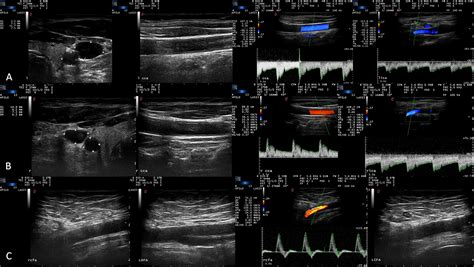 Deep Femoral Artery Ultrasound