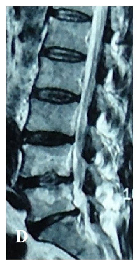 A Discitis And Osteomyelitis Are Seen On This T Weighted Mr Image Of