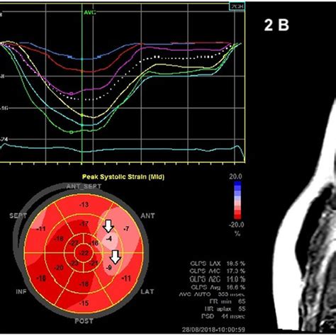 The Example Of Late Gadolinium Enhancement Lge − In A Patient With