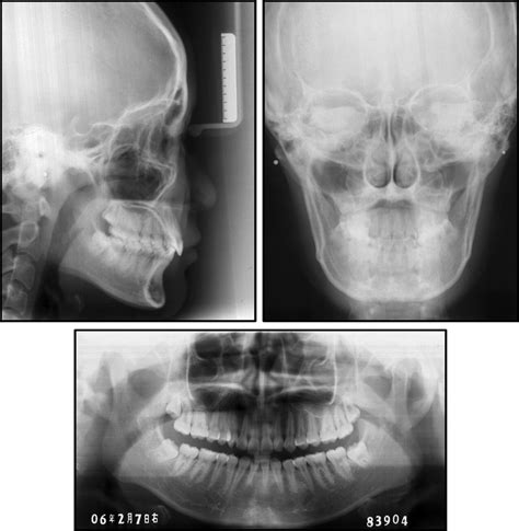 Use Of Forsus Fatigue Resistant Device In A Patient With Class I