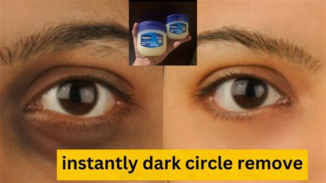 Only Vaseline Viral Dark Circles Bye Removal Korean Remedy Dark Circles