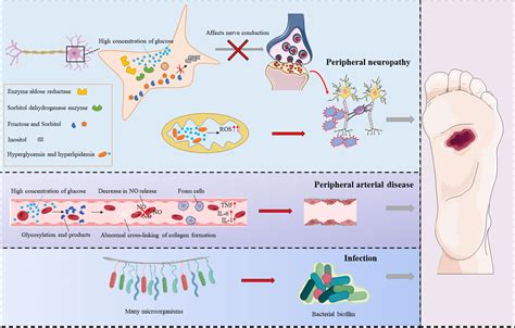 Frontiers Current Status And Progress In Research On Dressing Management For Diabetic Foot Ulcer