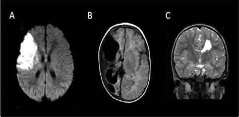 Perinatal Stroke Syndromes A Neonatal Arterial Ischemic Stroke