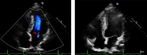 Cardiac Echocardiography Showed Asymmetric Left Ventricular Hypertrophy