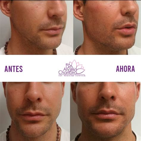 Masculinización facial Doctora Angela Chamorro