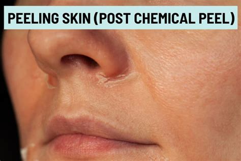 Dry And Peeling Skin Around Nose 13 Causes And How To Treat It