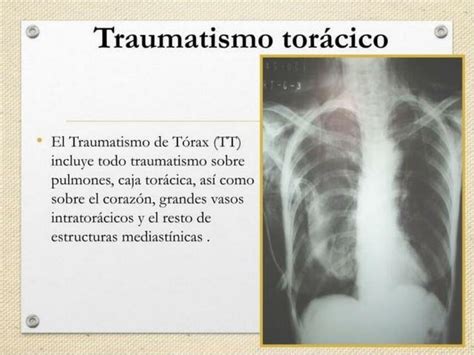 Traumatismo torácico Alef Douglas Machado uDocz