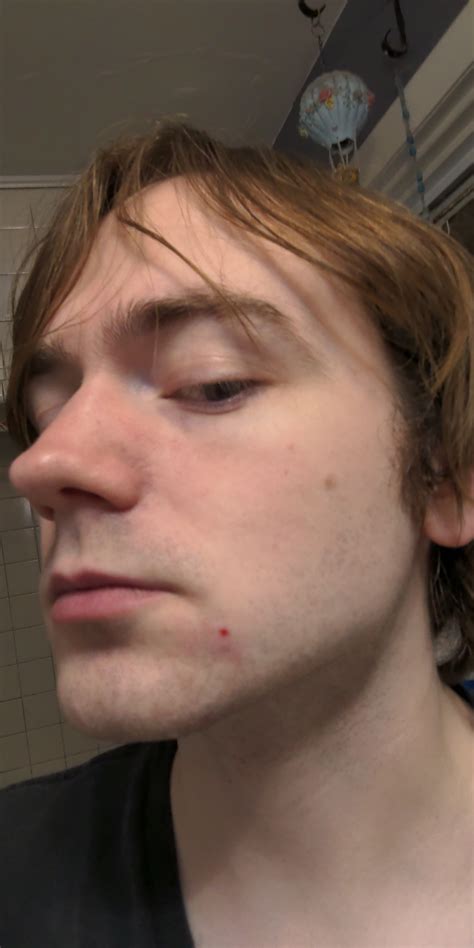 Just Popped A Pimple And Now Theres A Red Spot That Doesnt Go Away